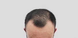 看了碧蓮盛和瑞麗詩(shī)的案例后我媽讓我去北京碧蓮盛做植發(fā)