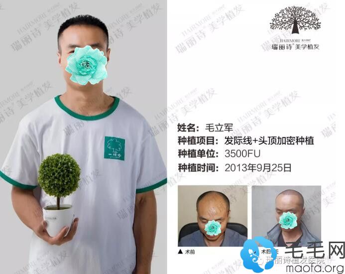 男士大面积脱发在瑞丽诗植发案例前后效果对比