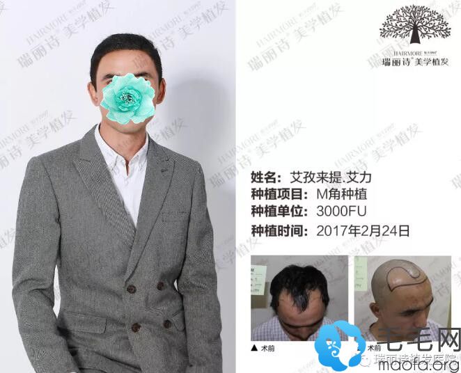 男士额角在瑞丽诗种植后效果图