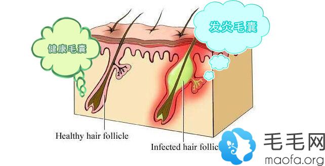 什么是毛囊炎呢？如果是毛囊炎的话该怎么办