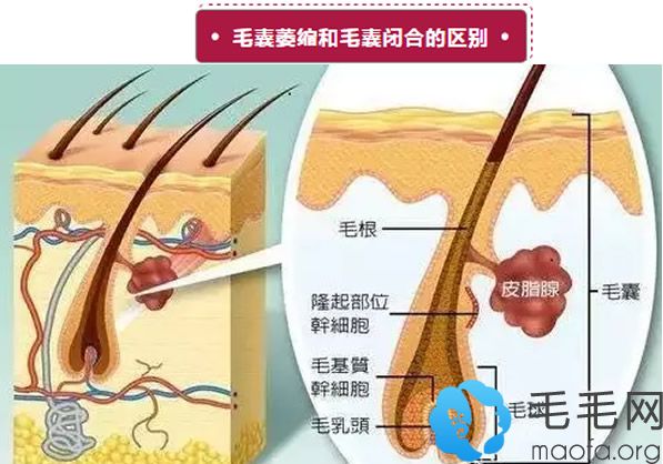 毛囊萎缩和毛囊闭合区别在哪里