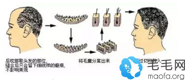 植发原理示意图