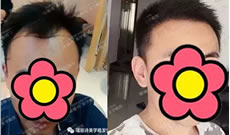 小姐姐和男友在郑州瑞丽诗植发种了发际线 效果老帅了
