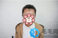 去深圳有名的植发深圳鹏程做完植发后拿到植发价格表