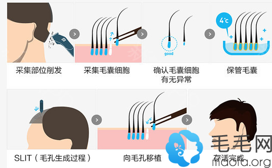 杭州连天美发际线种植过程图