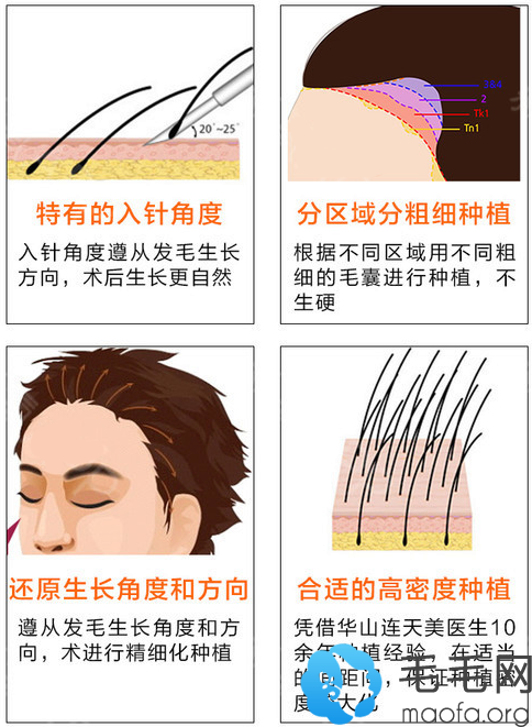 杭州连天美植发技术优势