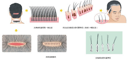 FUT植发技术手术全程示意图