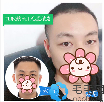 广州曙光刘杰伟医生做的FUN发际线种植案例