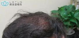 植发后继续脱发怎么办?如何做才能避免植发后原生发的脱落?