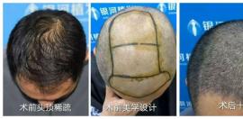 植发怎么样?搜集了一份近期银河植发案例及价格表