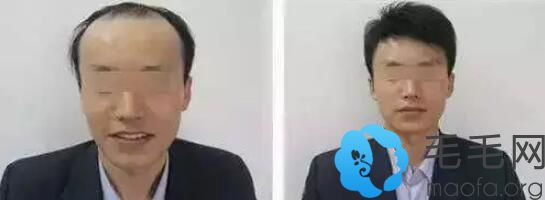 长沙美莱男士头顶光秃植发案例