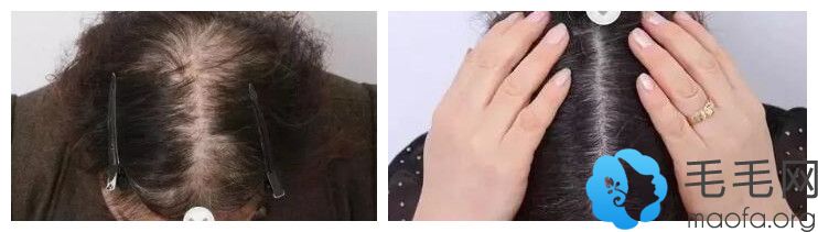 女性发缝稀疏植发后效果对比 