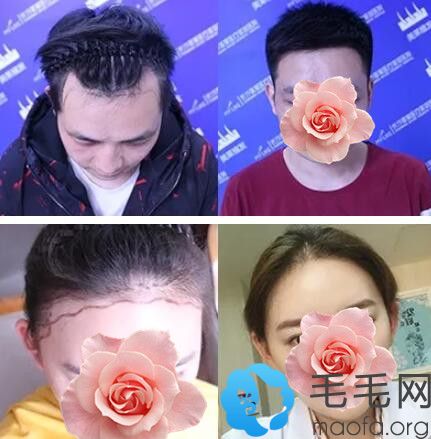 长沙美莱男女发际线种植案例前后效果对比