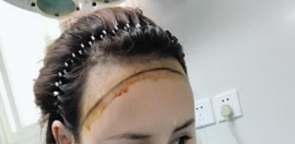 成都艾米丽刘叔阳植发2600单位效果 看发际线种植效果对比图