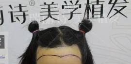 我在哈尔滨瑞丽诗植发受骗了吗 真人案例图片和价格来告知