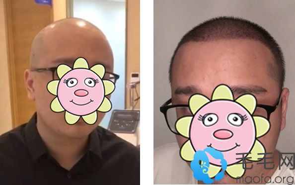 笑笑在杭州碧莲盛植发效果