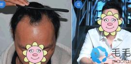 为什么明星不植发?别傻了!明星植发成功的案例和图片有很多