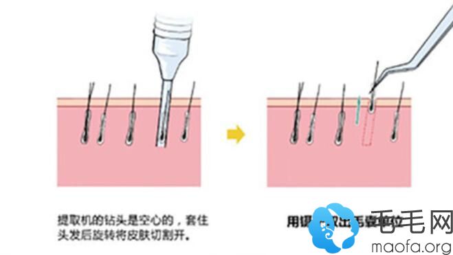 上海伯思立植发过程图