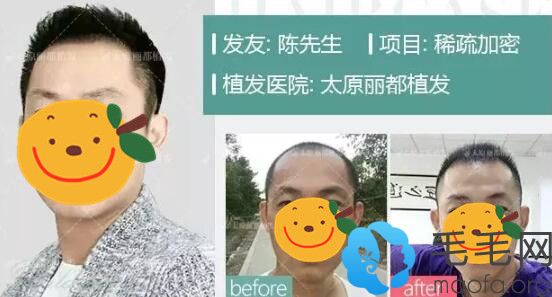 植发靠谱吗?看她和他真人植发案例及术后效果反馈