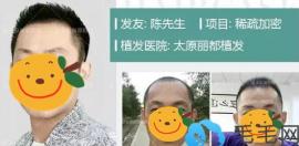 植發(fā)靠譜嗎?看她和他真人植發(fā)案例及術(shù)后效果反饋