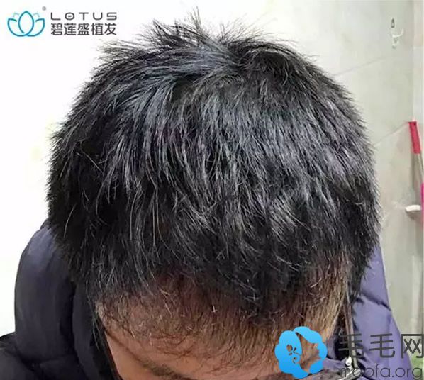 昆明碧莲盛种植发际线9个月的恢复效果图