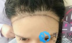 到植发面诊2次后终于让熊雯医生帮我种植发际线了