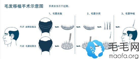 植发过程示意图