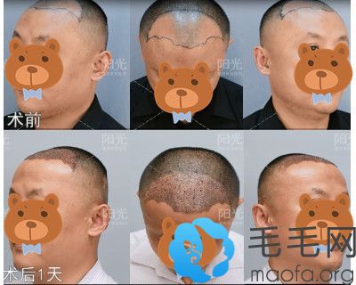 深圳阳光头发加密种植案例