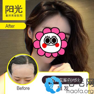 深圳阳光女士种植发际线效果