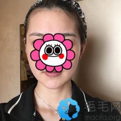想改善发际线过高看我到杭州艺星种植发际线1000单位效果图