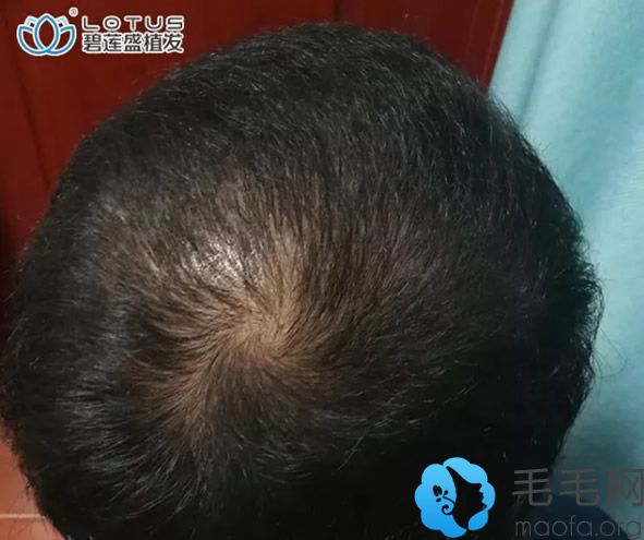 北京碧蓮盛植發(fā)6個月效果怎么樣