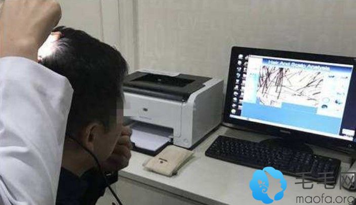 5级脱发治疗前需要进行毛囊检测