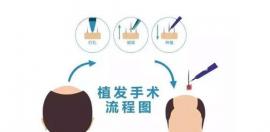 植发后不做理疗会怎么样?我植发3000单位已经花了2万多元了