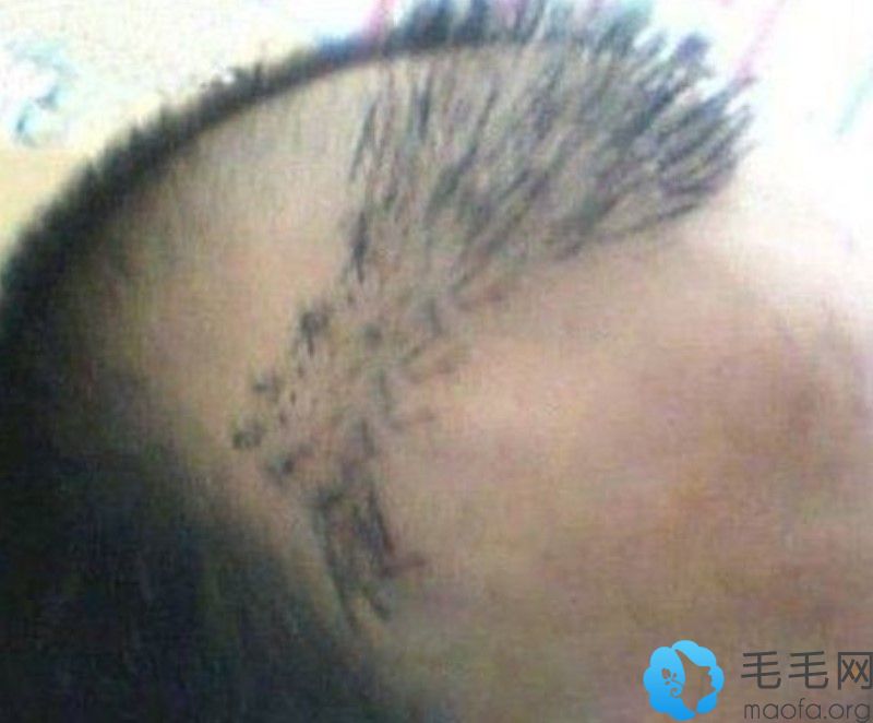 醫(yī)生技術(shù)會(huì)影響發(fā)際線種植效果