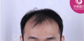上海华美植发中心怎么样?来看发友植发后口碑评价及价格表