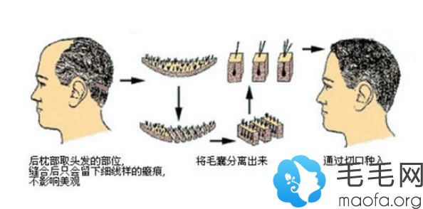 植发手术过程