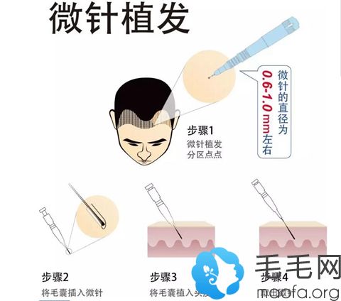 微针植发技术