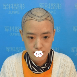 找重庆军科毛作源做发际线种植头顶加密我特意留了美人尖