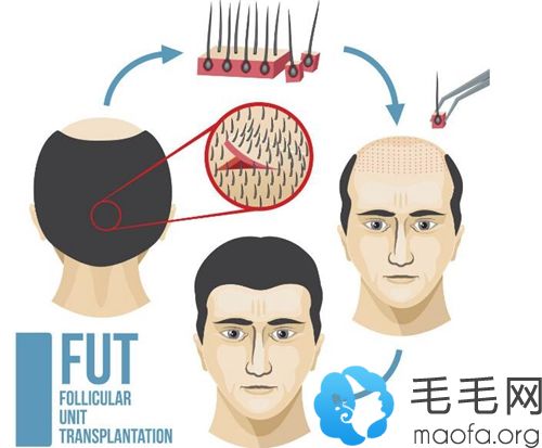 苏州维秘FUT植发技术