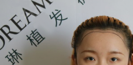 想知道杭州薇琳頭發(fā)種植技術好嗎?看我的美人尖種植效果圖