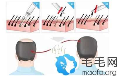 佛山华美头发种植原理