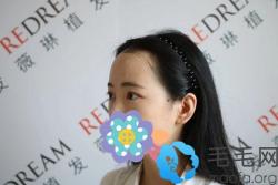 找上海薇琳植发陈凡凡做发际线种植一个月了 现上传效果图