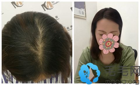 哈尔滨成美头顶加密种植案例