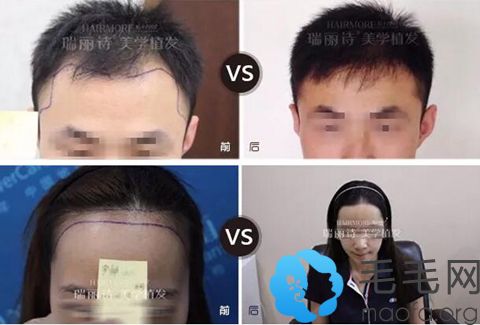 哈尔滨瑞丽诗植发案例
