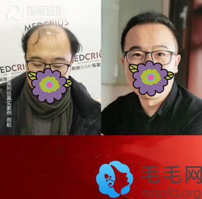 黑龙江瑞丽植发案例