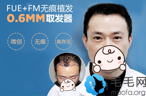 南京华美FUE+FM无痕植发案例效果及优势