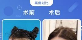 的BHT種植技術(shù)是它成為浙江靠譜植發(fā)醫(yī)院的原因