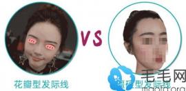 發(fā)現(xiàn)成都恒博植發(fā)醫(yī)院種植花瓣型發(fā)際線1500單位只需8400元起