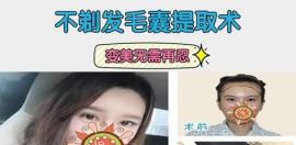 成都首瑞汪军2500元起的不剃发发际线种植让你告别大脑门儿