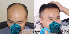 透过这些头顶加密种发际线案例会对瑞丽诗靠谱性有所认知